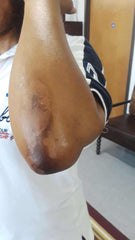 close-up of an elbow showing skin affected by melanin deposits treated with Solution For Elbow Hands & Feet