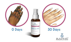 Wholesale 30ml labeled solution for hands and feet treatment showing before and after 30 days skin clarity improvement